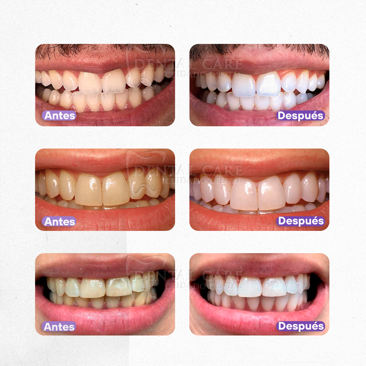 Blanqueador Dental - Sérum V34 (Comprá 1 y llévate 3)